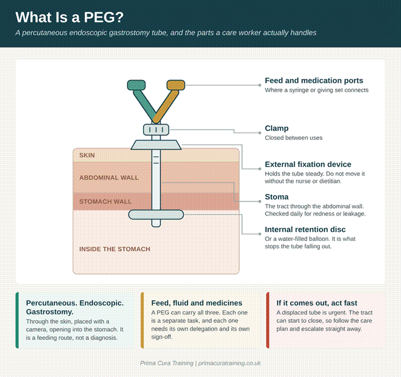 Labelled diagram of a PEG tube showing the feed and medication ports, the clamp, the external fixation device, the stoma tract through the abdominal wall, and the internal retention disc sitting inside the stomach.
